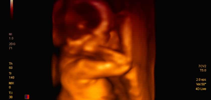 Q&A: Are 3D Ultrasounds Safe and Worth It?